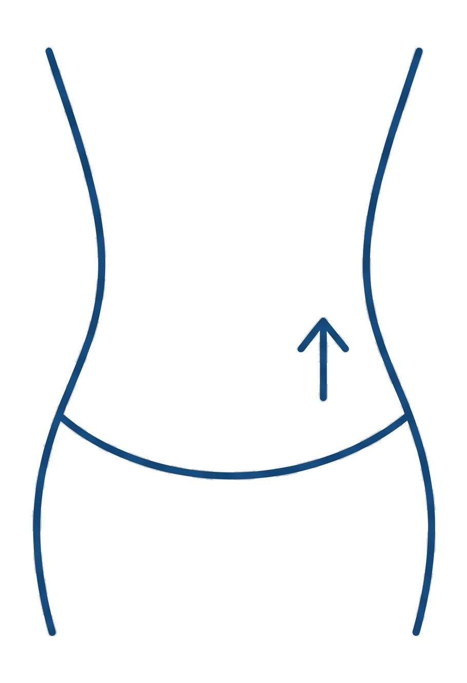 Abdominoplastía