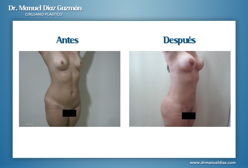 Antes y después — abdominoplastía, perfil