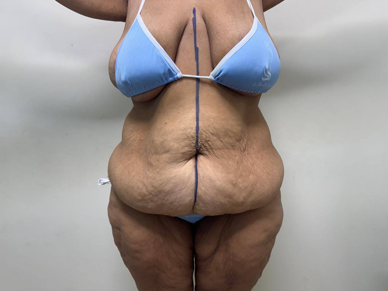 Before — Tummy Tuck