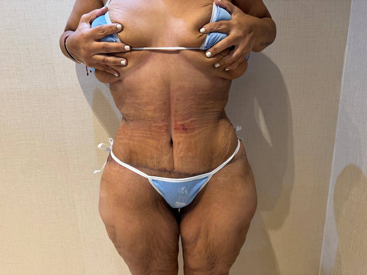 After — Tummy Tuck