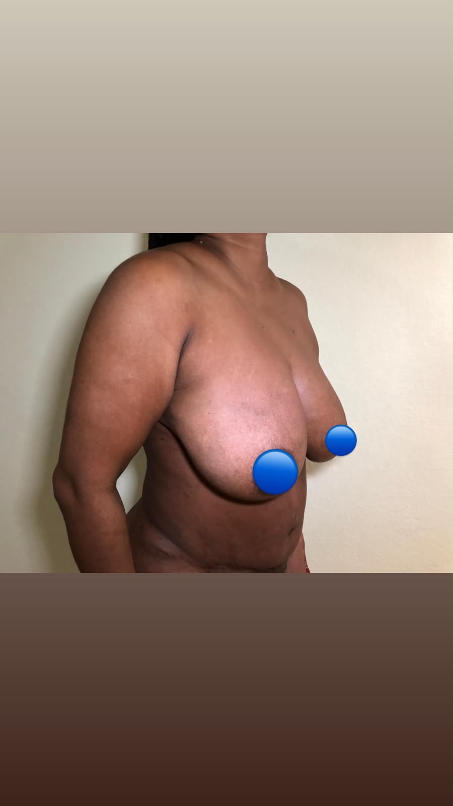 Before — Breast Augmentation