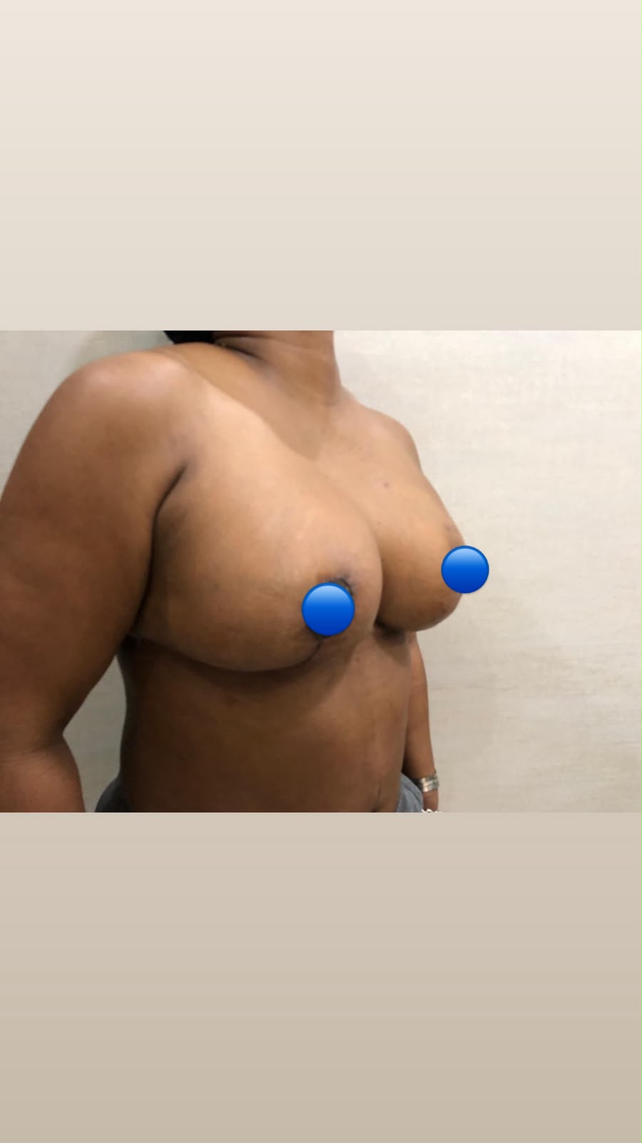 After — Breast Augmentation