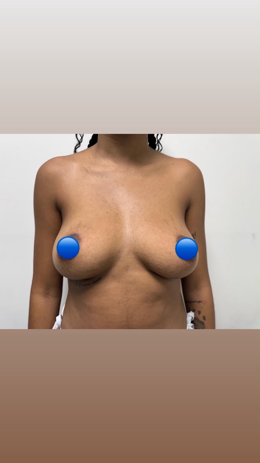 Before — Breast Augmentation