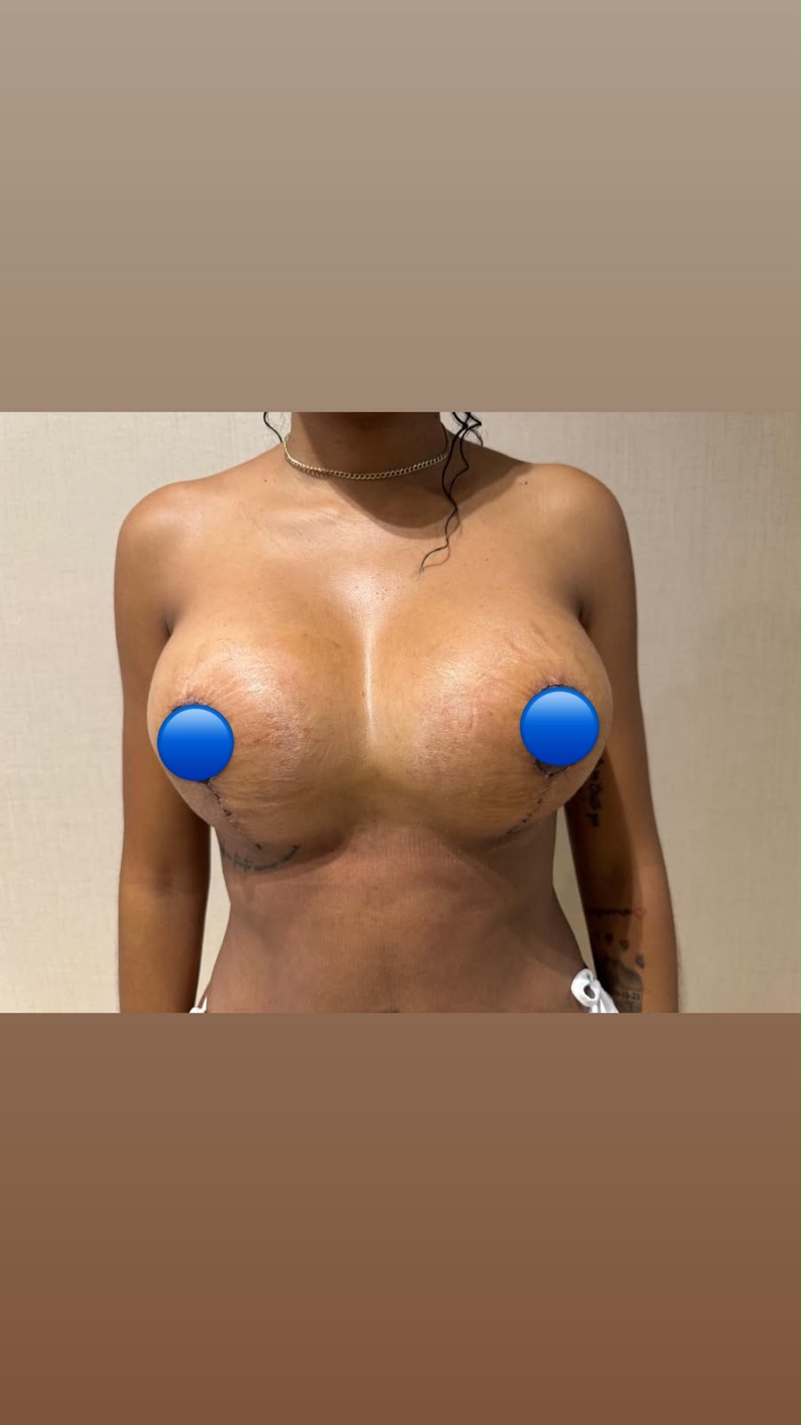After — Breast Augmentation