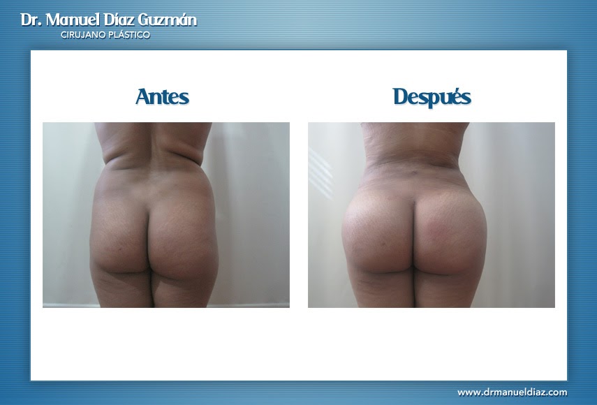 Antes y después — BBL, espalda