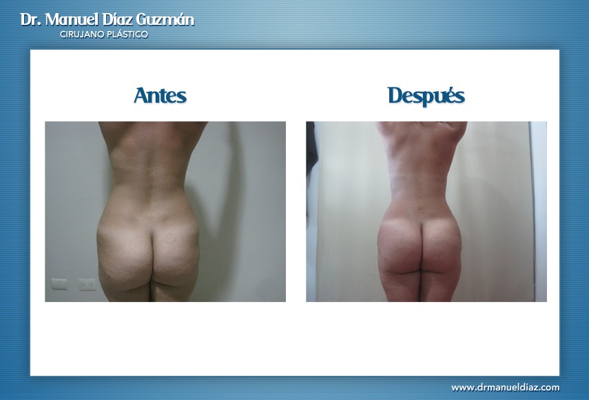 Antes y después — BBL, espalda