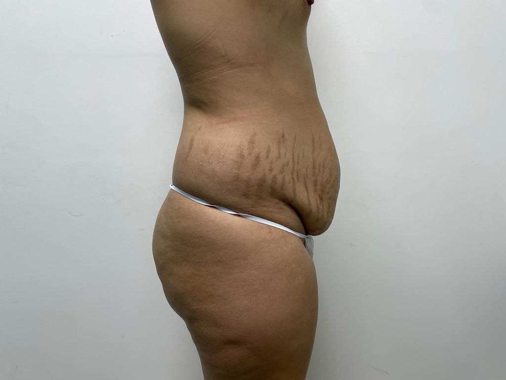 Before — BBL and Body Contouring
