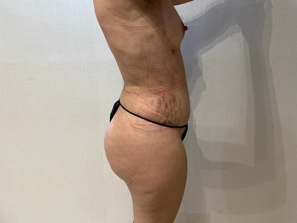 After — BBL and Body Contouring