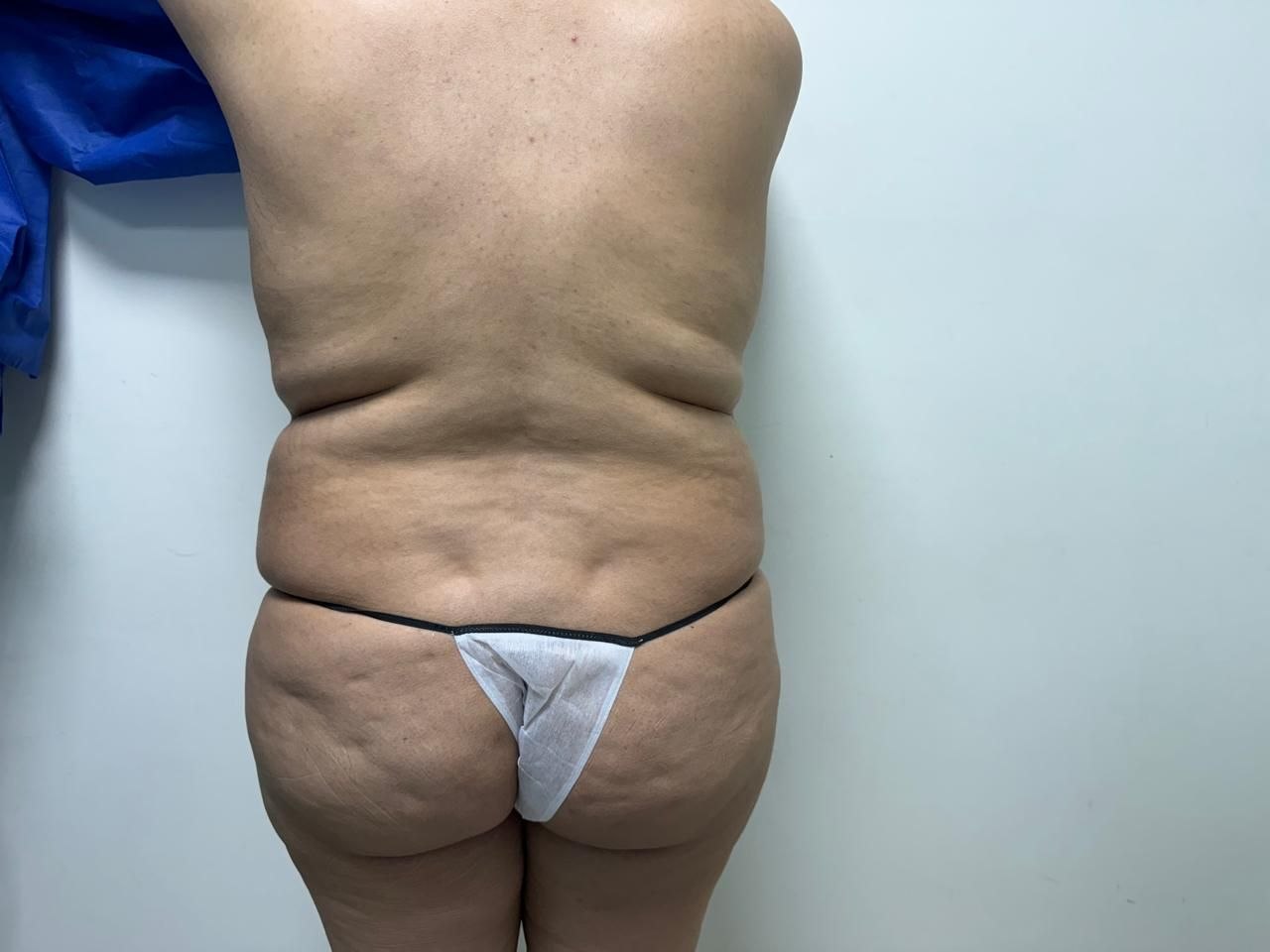 Before — BBL and Body Contouring