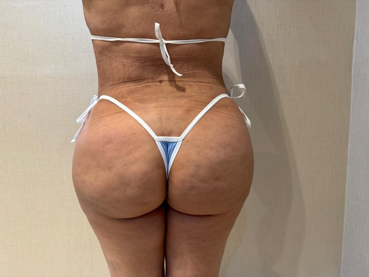 After — BBL and Body Contouring
