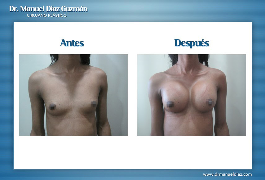 Antes y después — mamoplastía de aumento, frontal