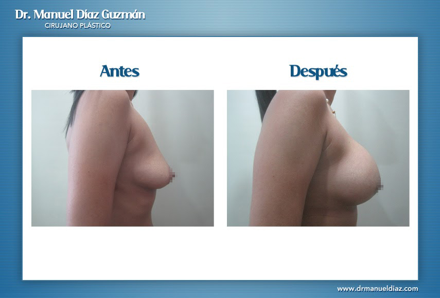 Antes y después — mamoplastía de aumento, perfil
