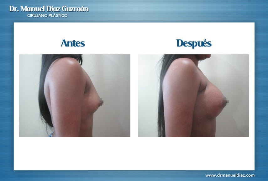 Antes y después — mamoplastía de aumento, perfil