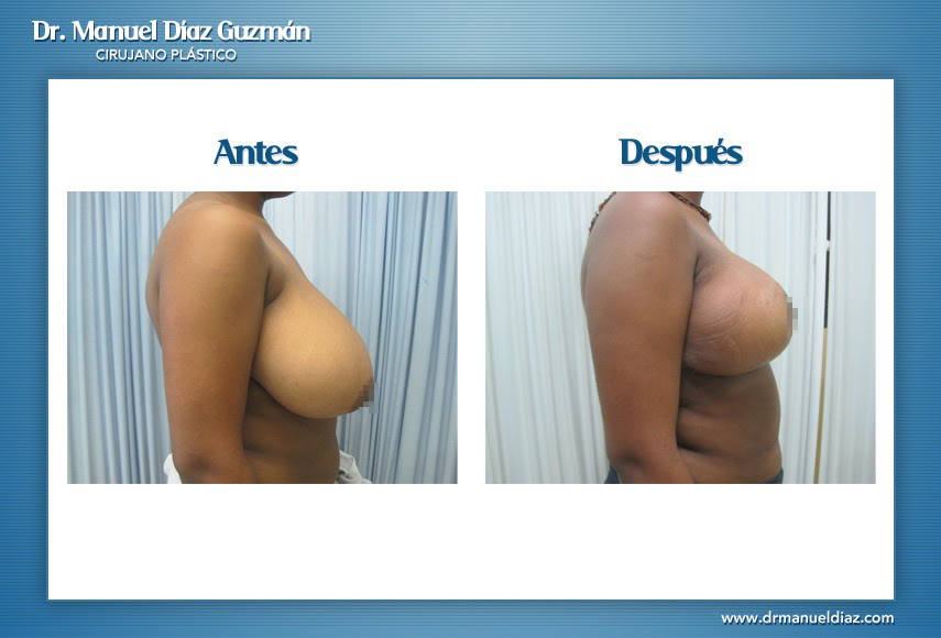 Antes y después — reducción de senos, perfil