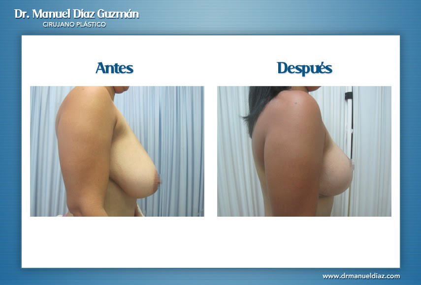 Antes y después — reducción de senos, perfil